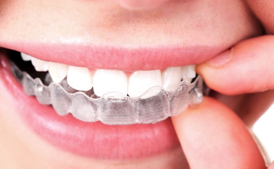 Avantages et inconvénients de l’orthodontie Invisalign