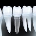 Un implant dentaire parmi entre des dents naturels