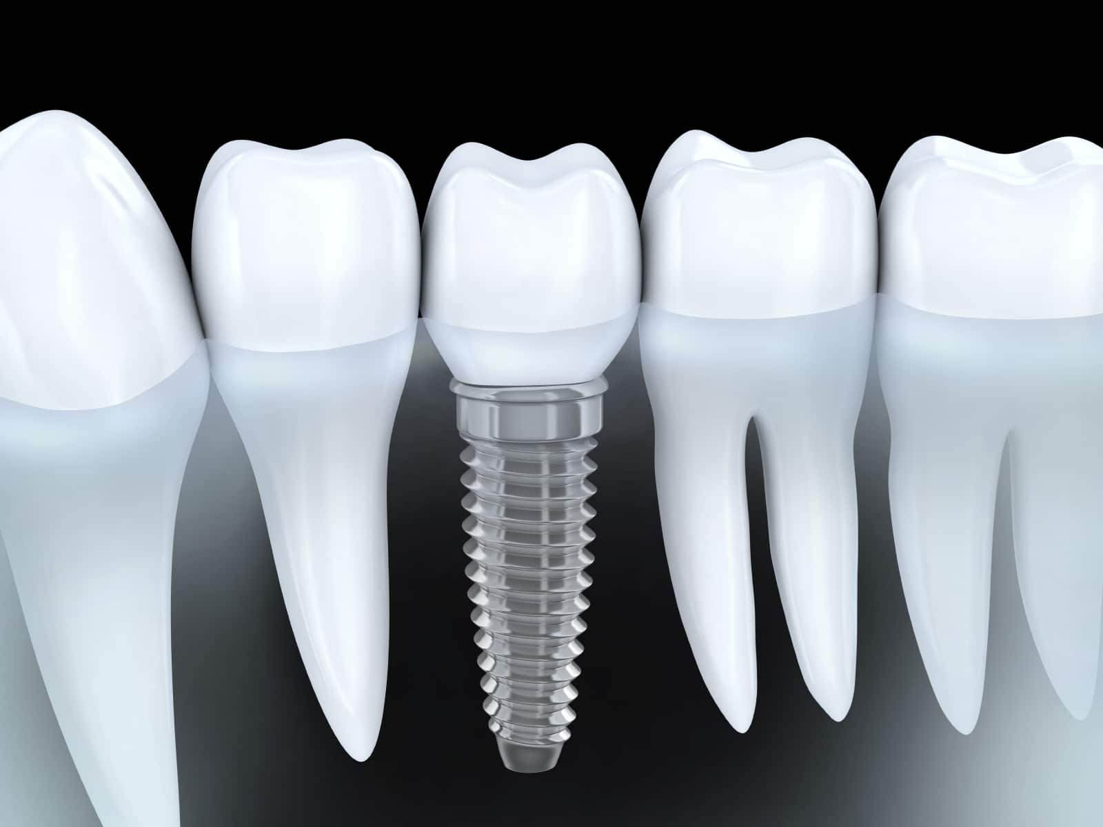 Implant dentaire types, pose, prix, remboursement et durée de vie Implant dentaire types, pose, prix, remboursement et durée de vie